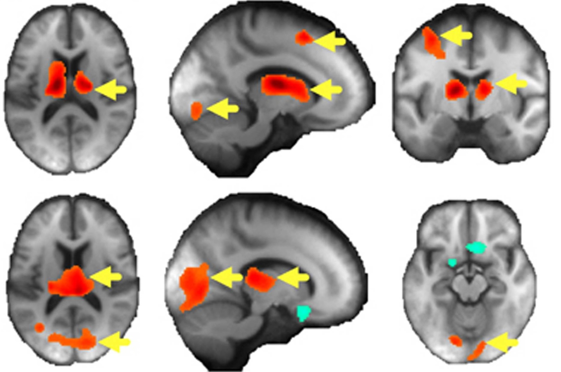 Andreescu & Colleagues Translational Psychiatry 2017