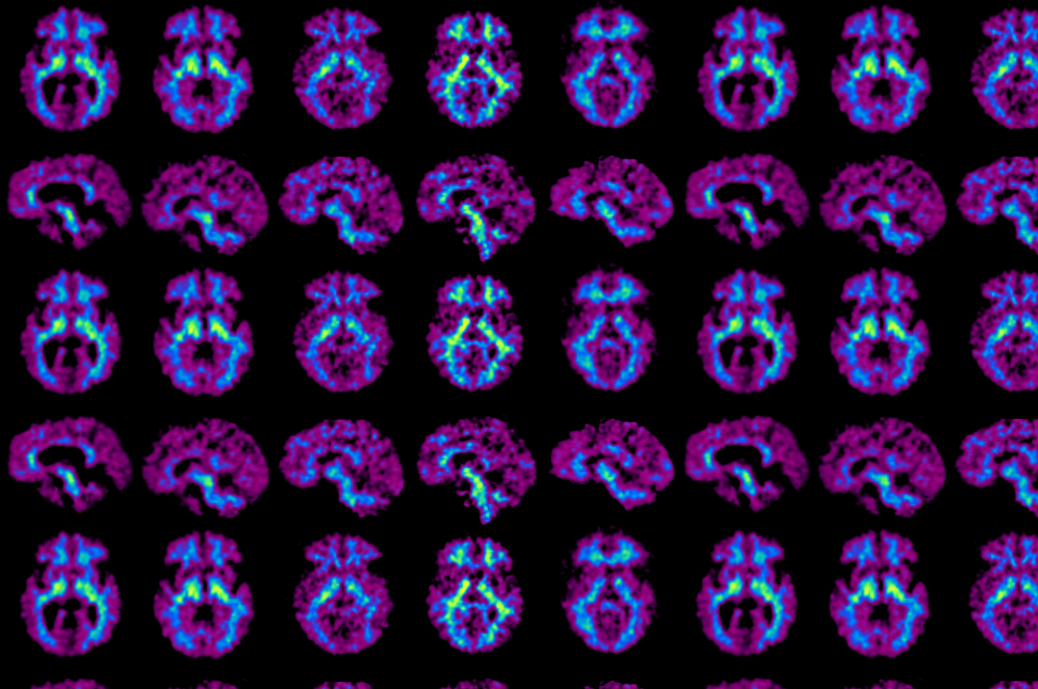 Cohen et al Alzheimers and Dementia 2018 Cohen et al Alzheimers and Dementia 2018