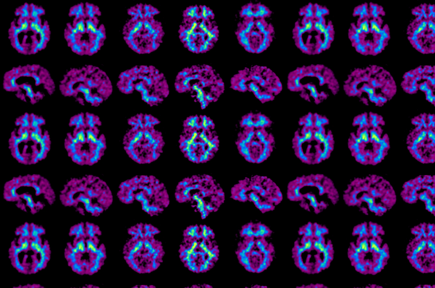 Cohen et al Alzheimers and Dementia 2018