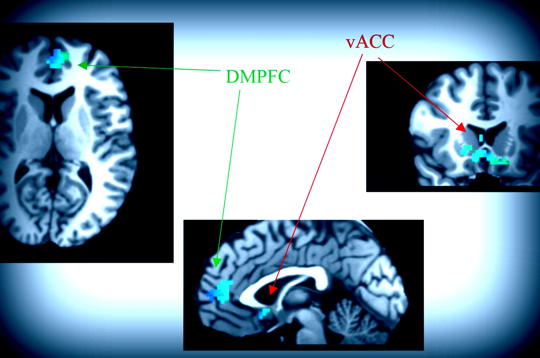 Price et al Biological Psychiatry 2018 Price et al Biological Psychiatry 2018