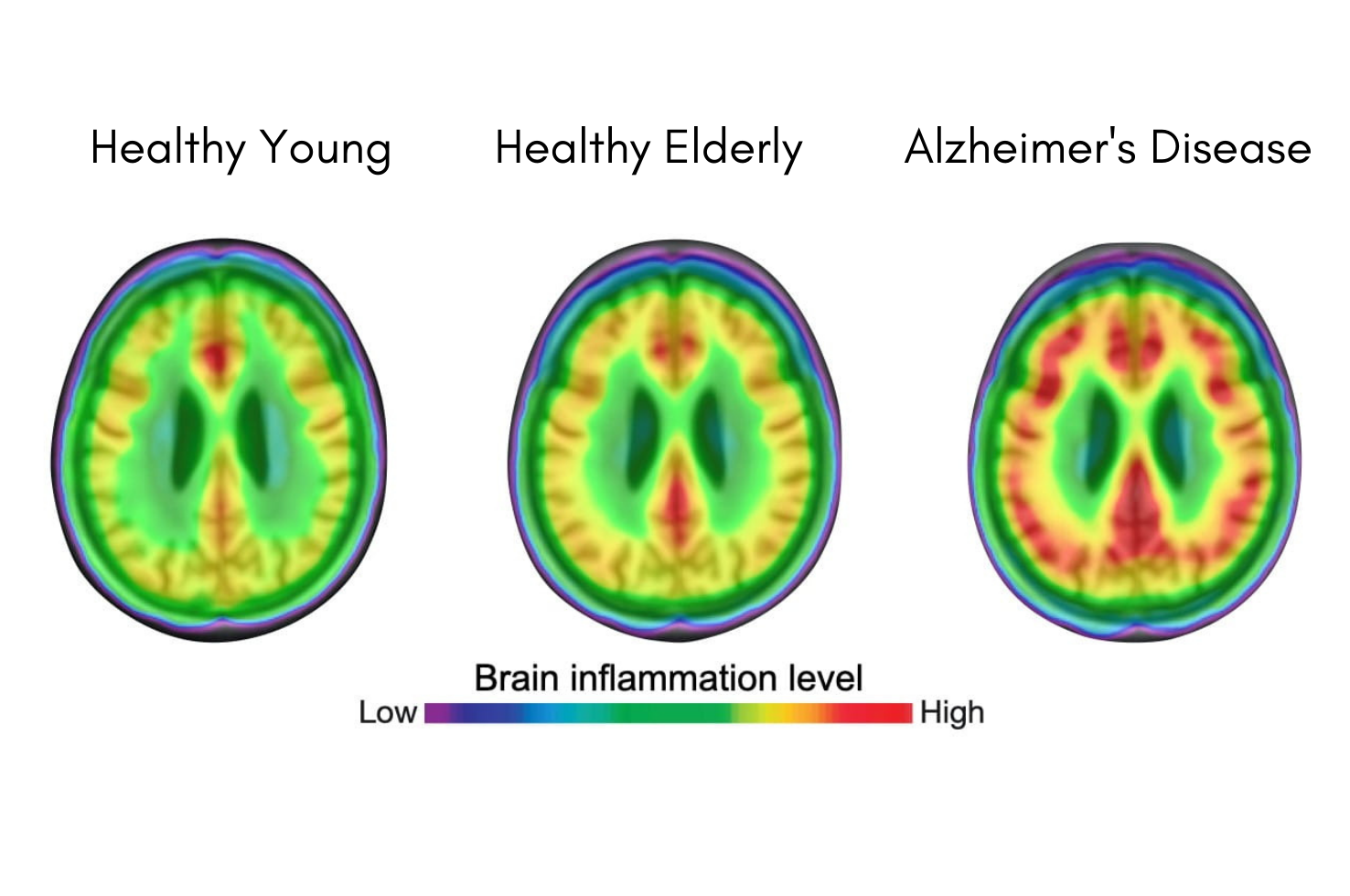 Nature Medicine: Microglial Activation Is Involved in the Spread of Tau Tangles in Alzheimer’s Disease Nature Medicine: Microglial Activation Is Involved in the Spread of Tau Tangles in Alzheimer’s Disease