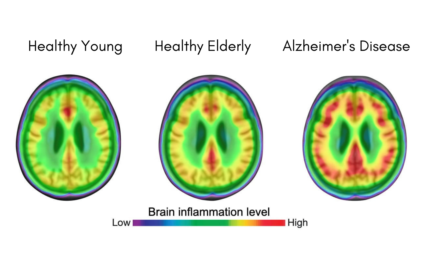 Nature Medicine: Microglial Activation Is Involved in the Spread of Tau Tangles in Alzheimer’s Disease