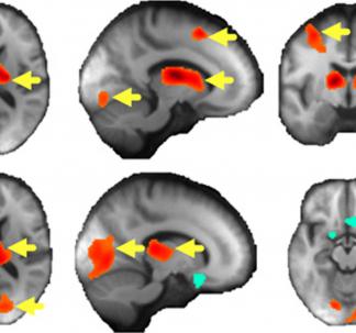 Andreescu & Colleagues Translational Psychiatry 2017