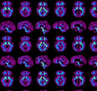 Cohen et al Alzheimers and Dementia 2018