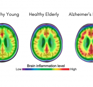 Nature Medicine: Microglial Activation Is Involved in the Spread of Tau Tangles in Alzheimer’s Disease